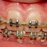 cost of teeth braces in Thailand